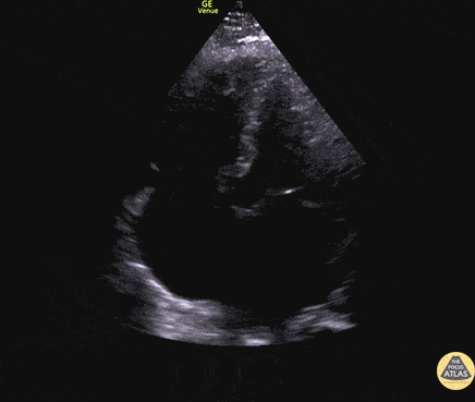 Left Ventricular Dysfunction - Biventricular Failure Apical 4