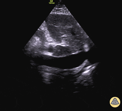 IVC & Abnormal Venous Waveforms - Plethoric IVC in Biventricular Failure