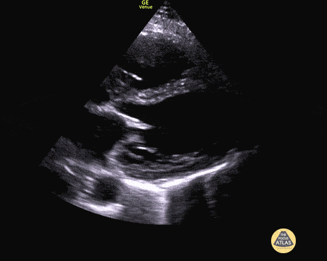Left Ventricular Dysfunction - Biventricular Failure Parasternal Long