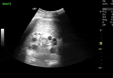 Renal/GU - Incidental Polycystic Kidney Disease