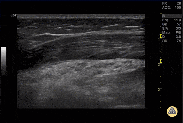 Musculoskeletal - Mildly Displaced Clavicle Fracture