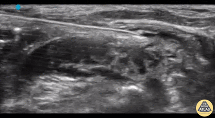 Nerve Block Gallery - Superficial Cervical Plexus Block