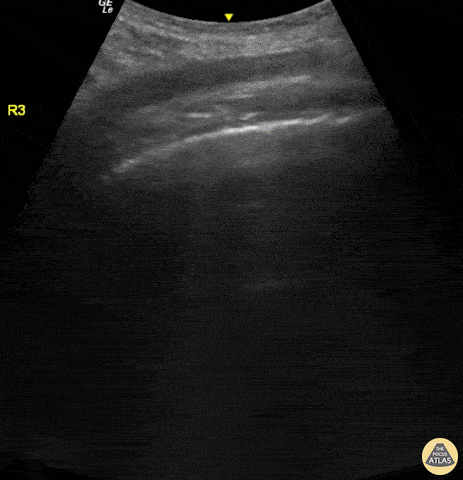Pulmonary - Light Beam Sign