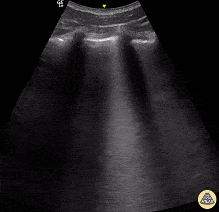 Pulmonary - Pulmonary Contusion