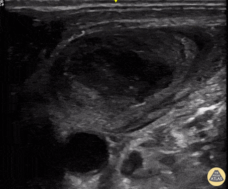 Vascular - Internal Jugular Thrombus