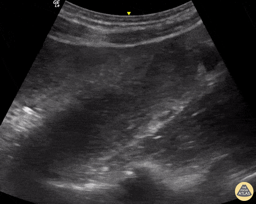 Bowel-GI - To & Fro in Bowel Obstruction