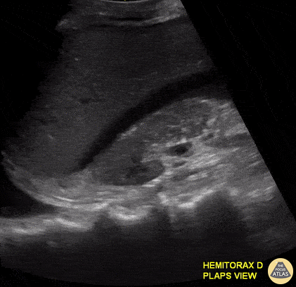 Trauma - Free Fluid in Morrison's Pouch