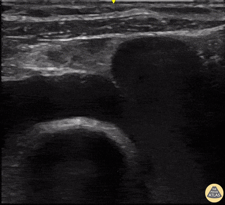 Vascular - Subclavian Vein