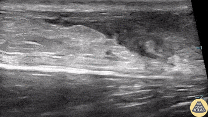 Musculoskeletal - Ruptured Achilles Tendon