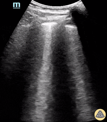 Pediatrics - COVID-19 Pneumonia