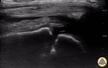 Pediatrics - Knee Effusion