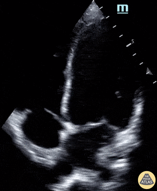 Pediatrics - COVID-19 Myocarditis