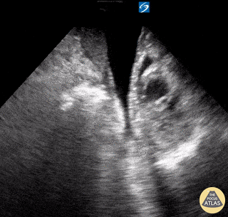 Right Ventricular Dysfunction - Obstructive Shock & RUSH