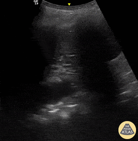 Pulmonary - Dynamic Air Bronchograms