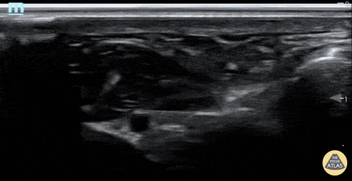 Nerve Block Gallery - Ulnar Nerve Block