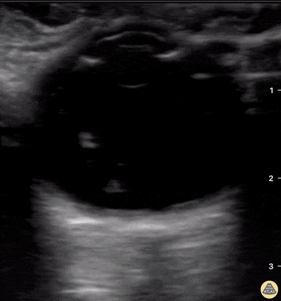 Orbital - Endogenous Endophthalmitis