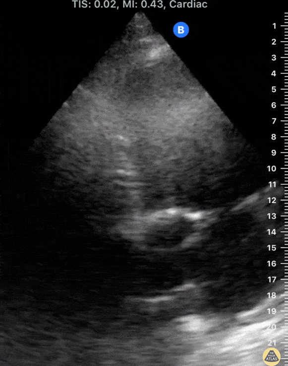 Left Ventricular Dysfunction - Bi-ventricular Failure in Vasculitis