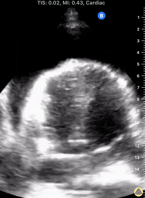 Pericardial Disease - Cardiac Tamponade with Swinging Heart