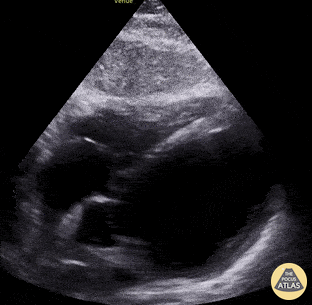 Left Ventricular Dysfunction - Drug-induced Cardiomyopathy