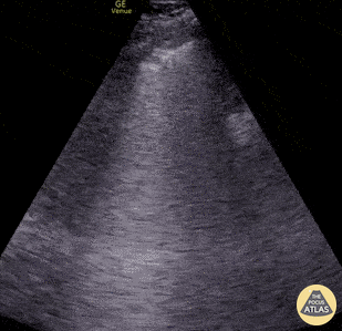 Pulmonary - COVID-19 Pneumonia