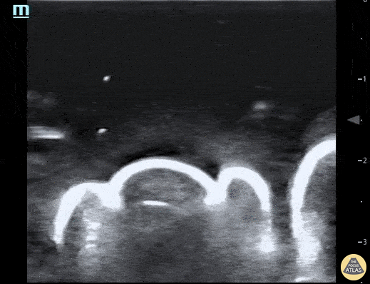 Musculoskeletal - Water Bath POCUS