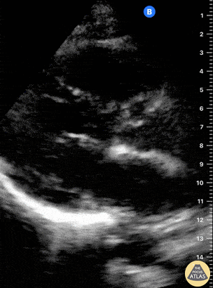 Normal Cardiac Anatomy - Normal PLAX