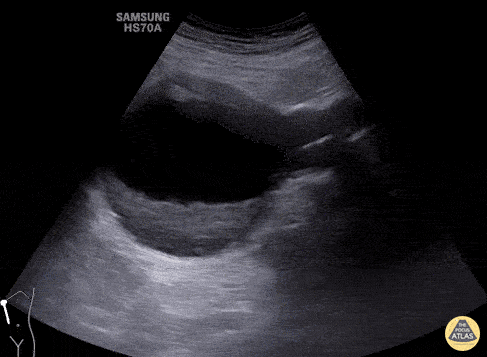 Aorta - Long Axis View of Large Abdominal Aortic Aneurysm