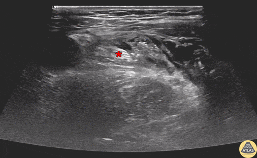 Nerve Block Gallery - Femoral Nerve Block