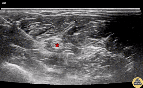 Nerve Block Gallery - Radial Nerve Block at the Elbow