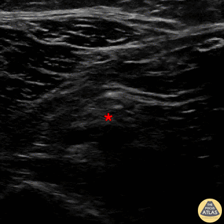 Nerve Block Gallery - Common Peroneal Block