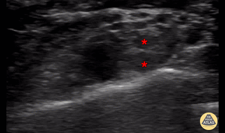 Nerve Block Gallery - Interscalene Brachial Plexus Block