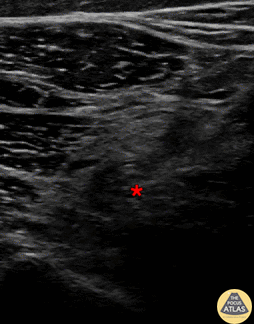 Nerve Block Gallery - Common Peroneal Block