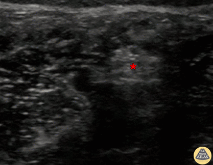 Nerve Block Gallery - Tibial Nerve Block