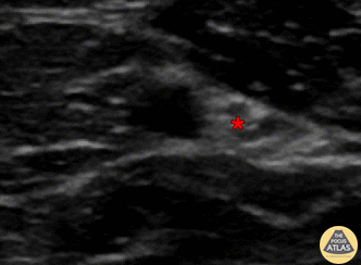 Nerve Block Gallery - Ulnar Nerve Block 2