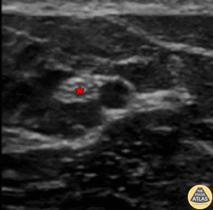 Nerve Block Gallery - Ulnar Nerve Block 3