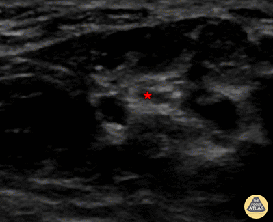 Nerve Block Gallery - Median Nerve Block 1
