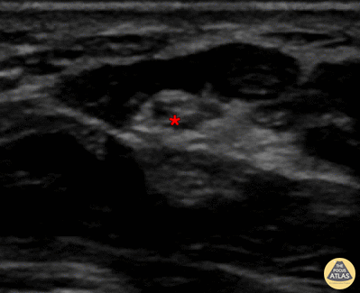 Nerve Block Gallery - Median Nerve Block 2