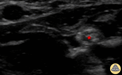 Nerve Block Gallery - Median Nerve Block 3