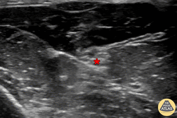 Nerve Block Gallery - Median Nerve Block 4