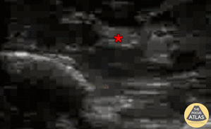 Nerve Block Gallery - Median Nerve Block 5