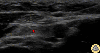 Nerve Block Gallery - Ulnar Nerve Block 4