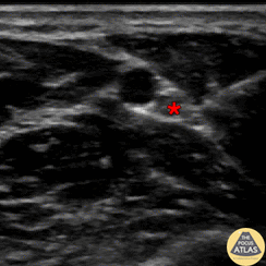 Nerve Block Gallery - Ulnar Nerve Block 5