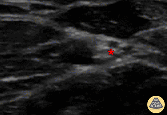 Nerve Block Gallery - Ulnar Nerve Block 6