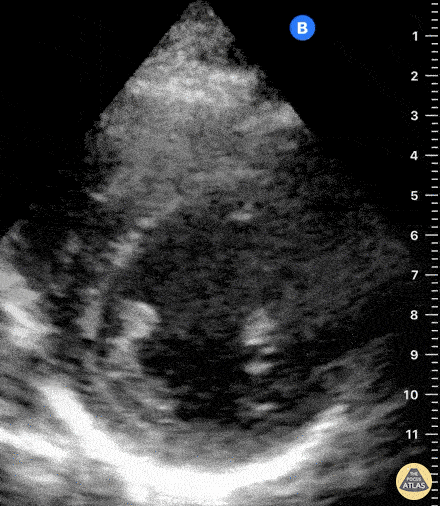Normal Cardiac Anatomy - Normal Parasternal Short Axis View