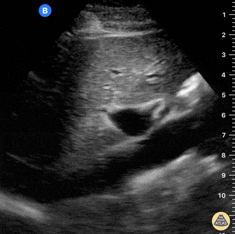 Aorta - Normal IVC to AA lateral drag - Longitudinal View