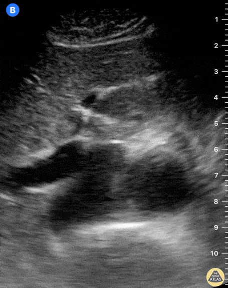 Aorta - Normal IVC and Aorta - Transverse view