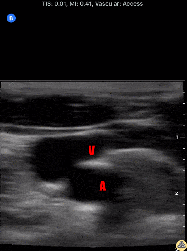 Nerve Block Gallery - Interscalene Anatomy