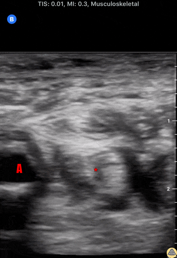 Nerve Block Gallery - Ulnar Nerve Block 7