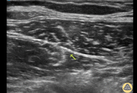 Nerve Block Gallery - Fascia Iliaca