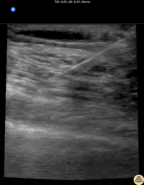 Nerve Block Gallery - Serratus Anterior Plane Block